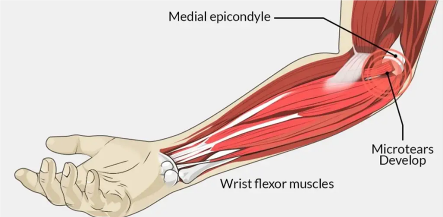 Golfers Elbow