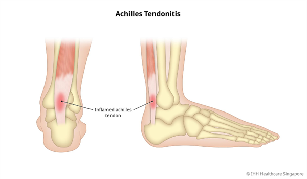 ACHILLES TENDINITIS/TENDINOPATHY