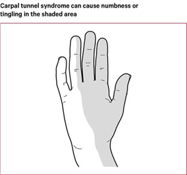 Carpal Tunnel Syndrome