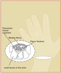 Carpal Tunnel Syndrome