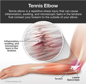 Tennis Elbow